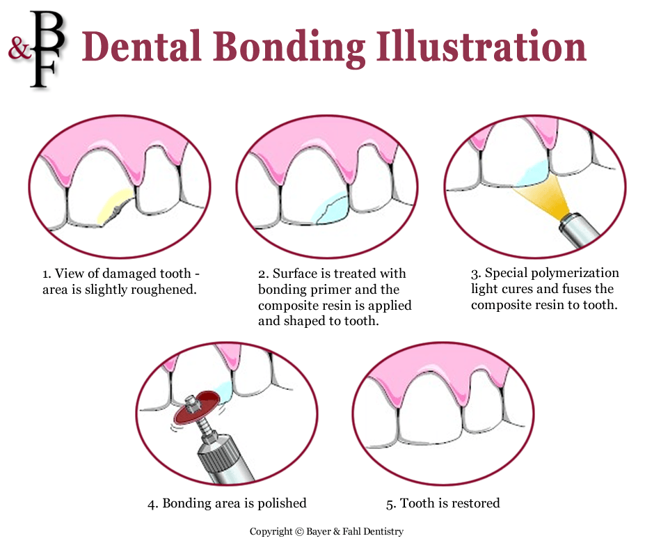 Bonding illustration