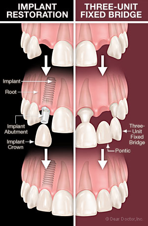 Bridges and Implants illustration