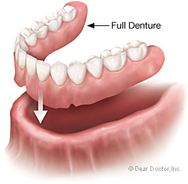 Full & Partial Dentures illustration
